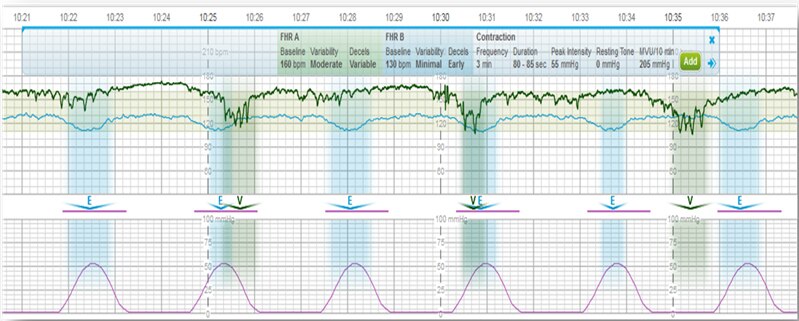 Centricity Perinatal Fetal Strip Monitor